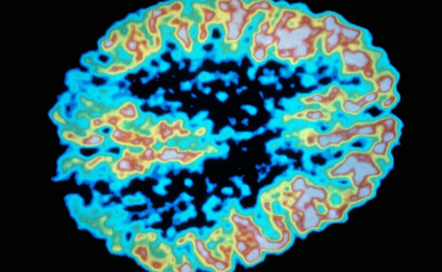 A PET scan shows metabolism of sugar in the human brain.