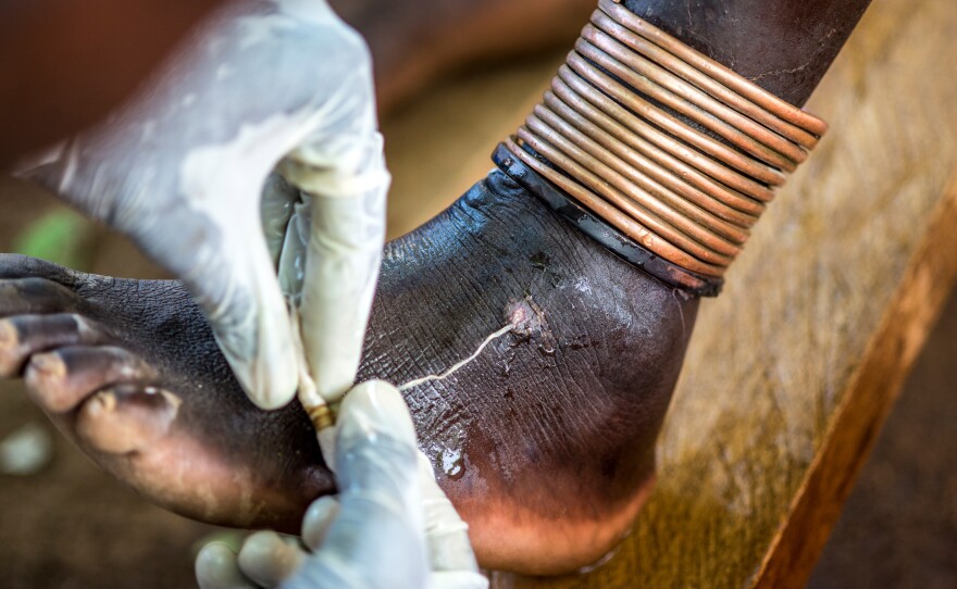 A health worker extracts a Guinea worm from a person's foot at a clinic in Eastern Equatoria State, South Sudan.