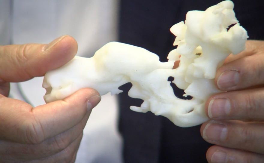 Larry Smarr holds a 3D-printed replica of the section of his colon removed in a recent surgery, Feb. 22, 2017.