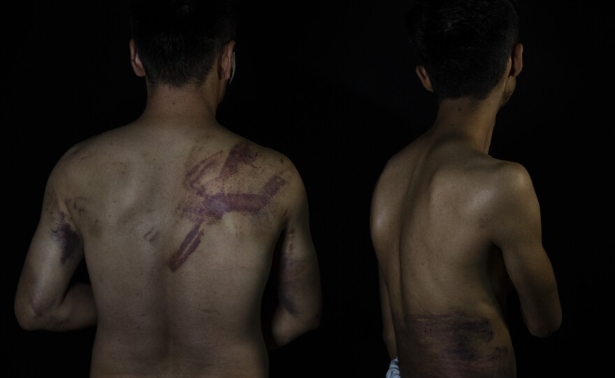Afghan journalists Nematullah Naqdi, 28, and Taqi Daryabi, 22, show their injuries at the <em>Etilaatroz</em> office in Kabul, Sept. 10. Taliban forces detained and beat them after they covered a women's protest in Kabul.