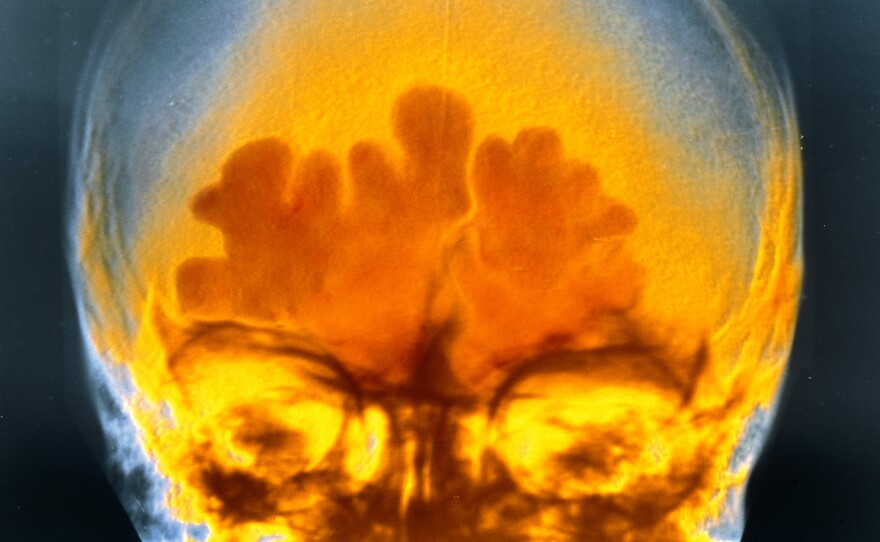 This is what the inflammation of sinus infection looks like in a false-color X-ray. It hurts even more in real life.