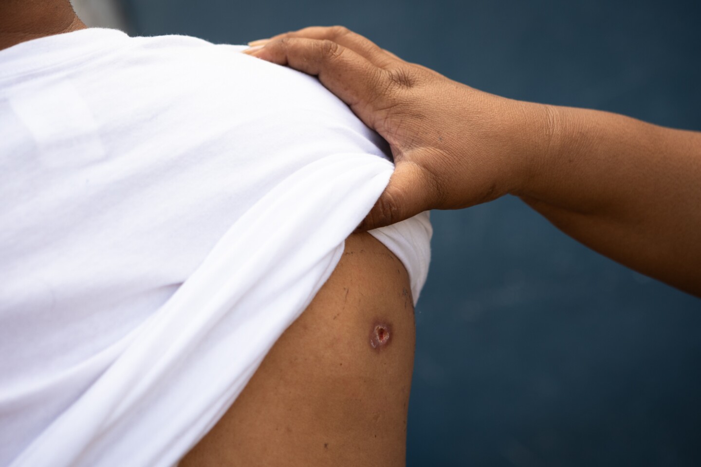 A woman from southwestern Mexico shows the bullet wound in her husband's shoulder, Oct. 22, 2023. They fled to Tijuana with their family to seek asylum in the United States.