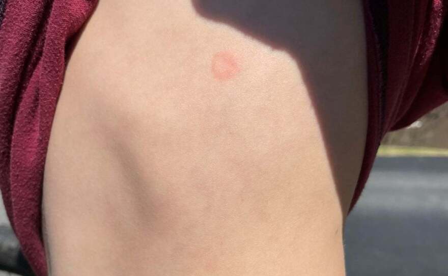 Police in Peachtree City, Ga., shared images on Facebook of a young boy who was hit by modified Orbeez balls while riding his bike.
