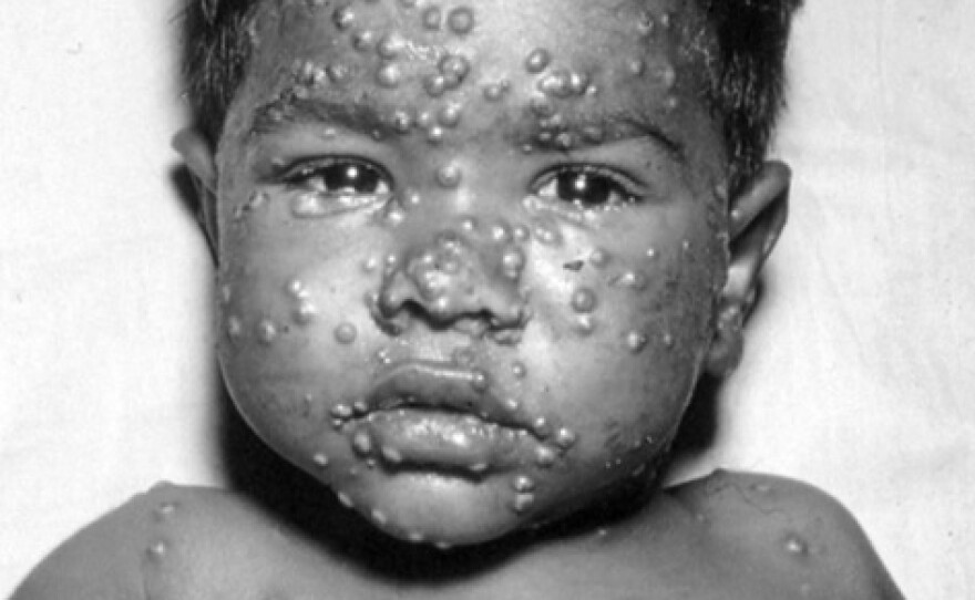 This was the image on a smallpox recognition card used by WHO in the 1970s to show people what smallpox looked like.