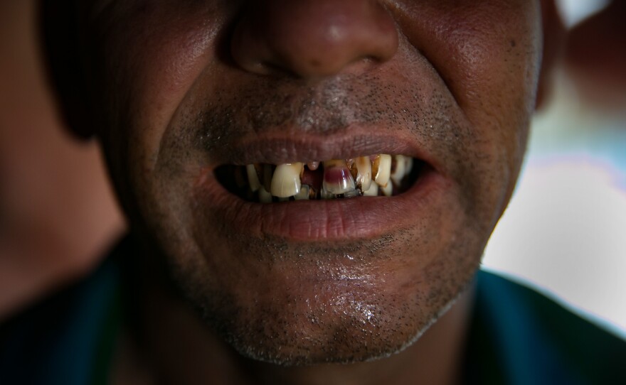 Sona Meah shows how the Myanmar military damaged his teeth.