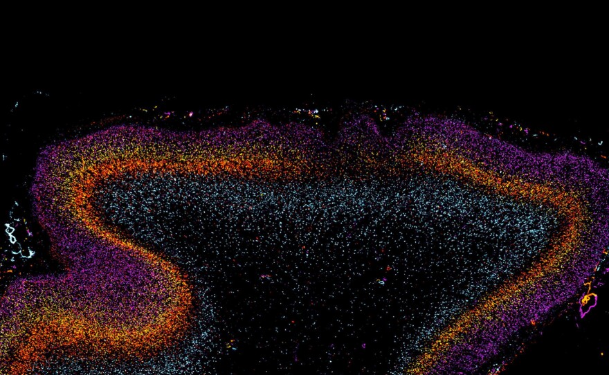 Disorganized patches in the autistic brain suggest the disorder develops during pregnancy.