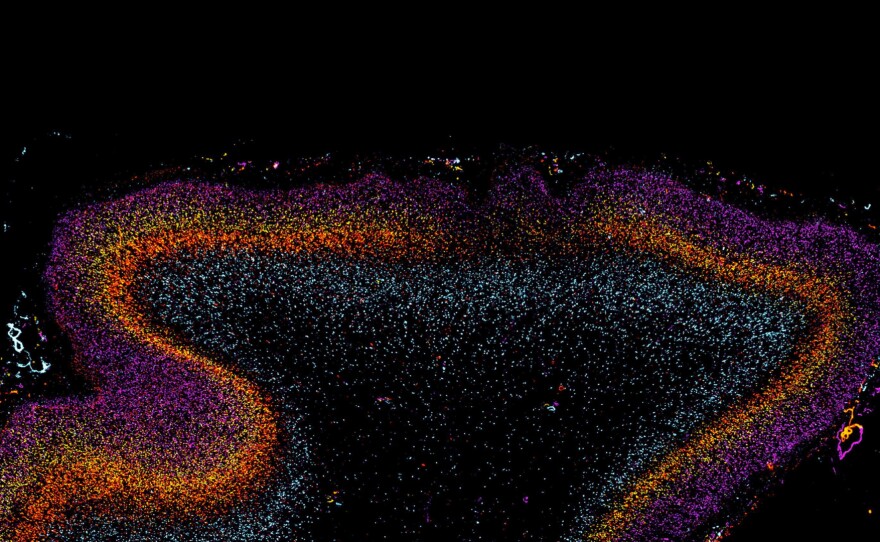 Disorganized patches in the autistic brain suggest the disorder develops during pregnancy. 