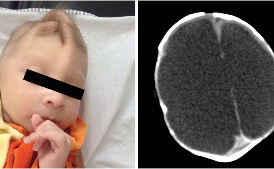 This baby was born with a normal-size head. But MRI scans show the brain is filled with fluid and little brain tissue. The cortex of the brain is normally folded, but in this case, the cortex is smooth.