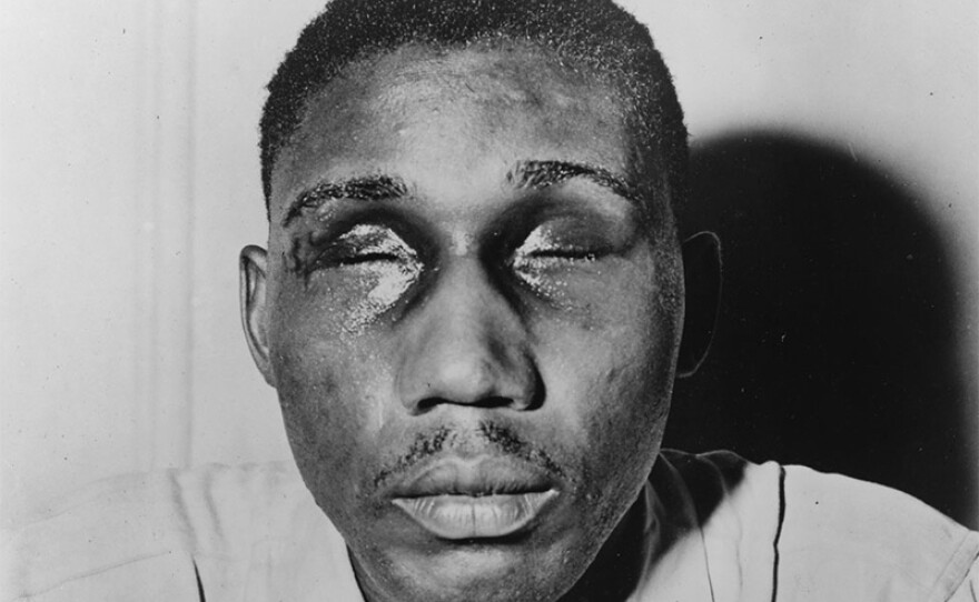 World War II veteran Isaac Woodard with eyes swollen shut from aggravated assault and blinding.