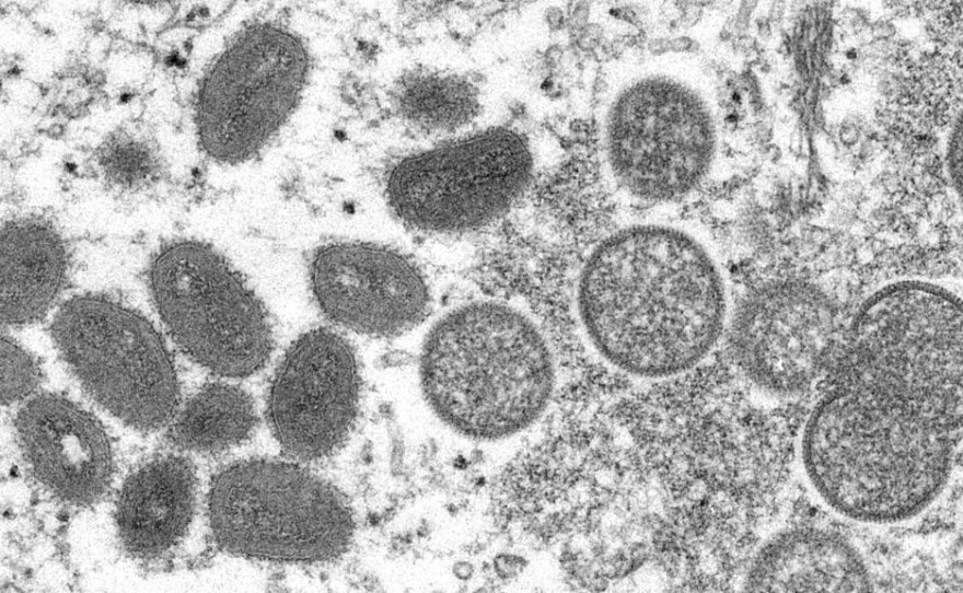 This 2003 electron microscope image made available by the Centers for Disease Control and Prevention shows mature, oval-shaped monkeypox virus particles, left, and spherical immature particles, right.