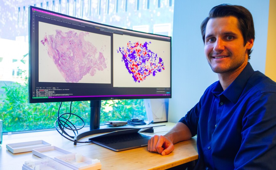 Post-doctoral researcher Erik Bergstrom shows images of a tissue sample from a tumor and a processed analysis of it, done by artificial intelligence. Undated photo