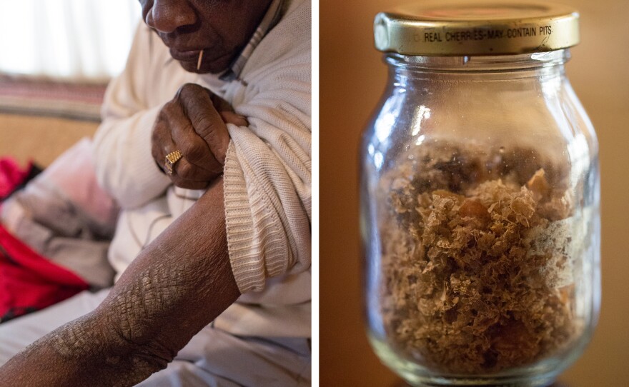 Rollins Edwards, who lives in Summerville, S.C., shows one of his many scars from exposure to mustard gas in World War II military experiments. More than 70 years after the exposure, his skin still falls off in flakes. For years, he carried around a jar full of the flakes to try to convince people of what happened to him.