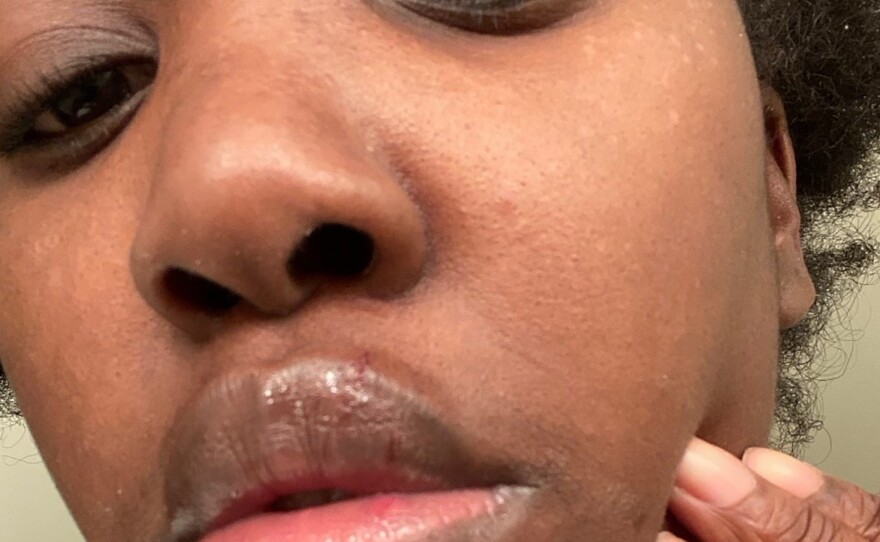 This undated selfie photo provided by Rickia Young shows her lip. Attorney Kevin Mincey, who represents Young, says she went to retrieve her 16-year-old nephew from the area were a protest was occurring, and put her 2-year-old son in the car to help him fall asleep.