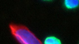Blood of woman with ovarian cancer.  The suspected circulating ovarian cancer cell (in red with a blue nucleus) is surrounded by normal blood cells (in green with blue nuclei).  