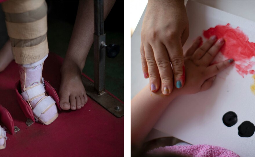 Left: Dos Santos' daughter uses leg braces to help her stand. Other symptoms of the disorder emerge as children grow. Right: Dos Santos guides her daughter to create a finger painting. "Our children are still here, they still have needs," she says.