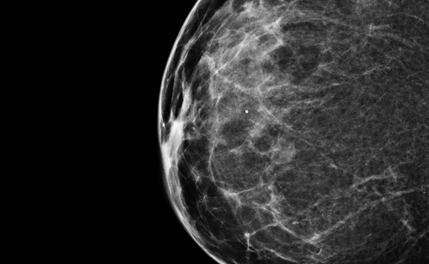 A 3-D mammogram reveals a normal breast.