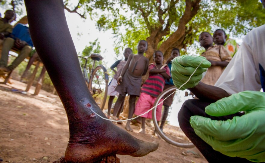 Medical worker Abaare Hussein extracts a Guinea worm from a child's leg in Savelugu Village in northern Ghana in 2007.