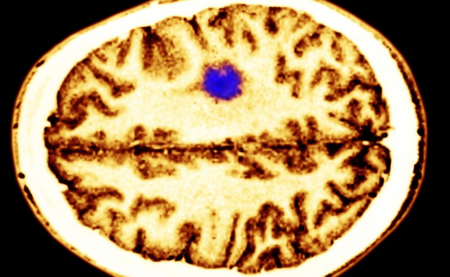 A color-enhanced cerebral MRI showing a glioma tumor.