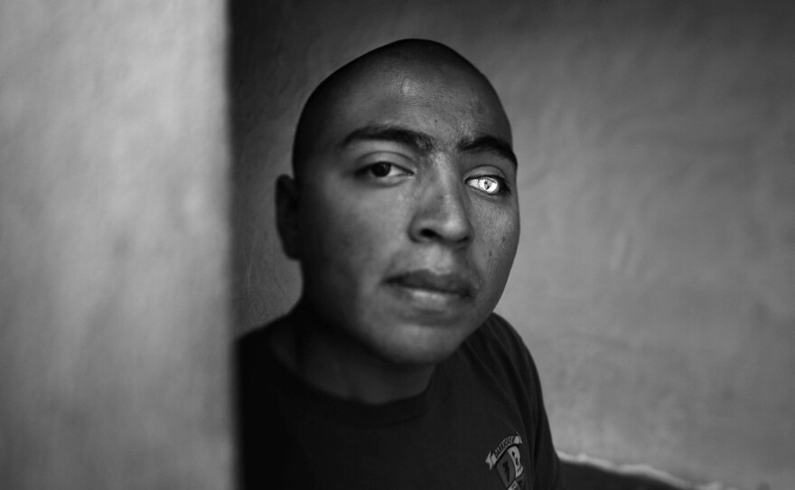 Josue Barron lost his left leg and eye in Sangin, Afghanistan, while serving with the 3/5 Marines from Camp Pendleton, Calif. He now has a glass eye which is emblazoned with the 3/5 insignia.