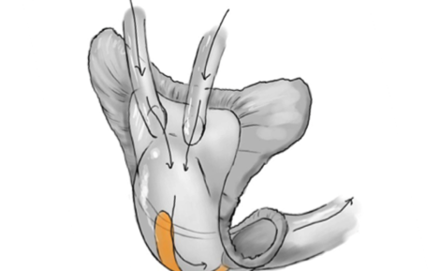 The SPUDs team — "Space Poop Unification of Doctors" — designed the Air-PUSH Urinary Girdle. They explain: "Air flows through the top of the device to direct urinary and/or menstrual waste in an anteroposterior direction, where it then exits via the larger tube at the bottom of the device."