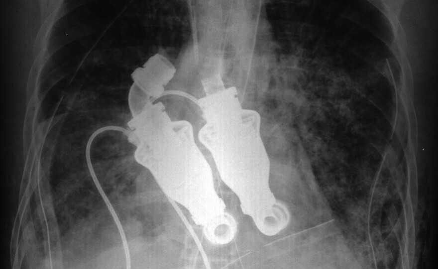 An X-ray shows the dual turbinelike blood pumps that replaced Craig Lewis' heart. These devices were used in a last attempt to save his life.