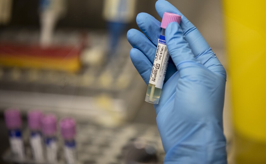 A medical technician shows a suspected monkeypox sample at the microbiology laboratory of La Paz Hospital on June 6 in Madrid. The World Health Organization is working with experts on changing the name of the virus.