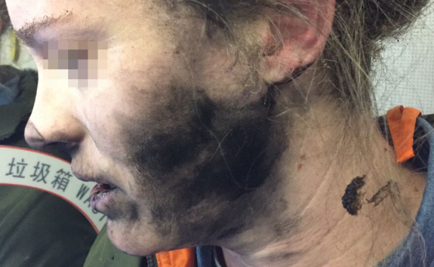 A photo provided by the Australian Safety Transport Bureau shows an airplane passenger whose headphones caught on fire midflight.