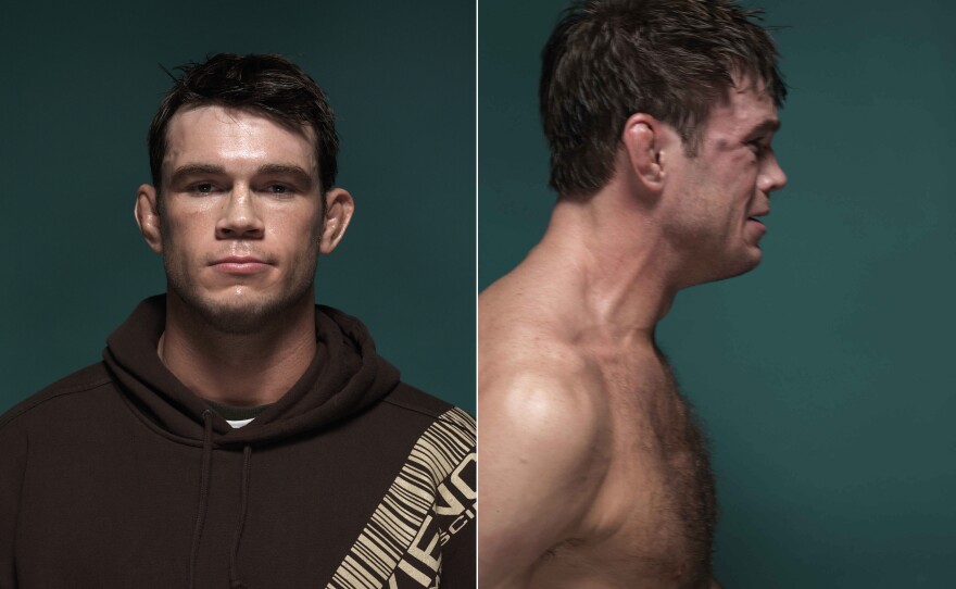 Forrest Griffin Before and After UFC 66, 2007  © Zuffa, LLC and Kevin Lynch