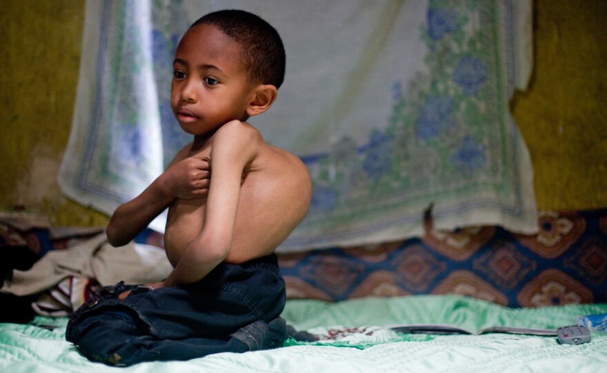 Sisay Gudeta, then age 7, sits on his bed at his home in Addis Ababa, Ethiopia, May 2013. At the time, his spine curved about 120 degrees. Without surgery, Sisay's scoliosis would have killed before age 18, doctors said.