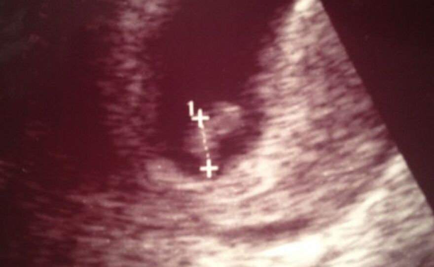 The first ultrasound of Stella that Mary was allowed to see.