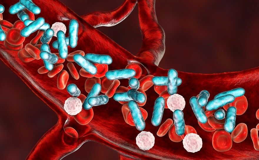 Sepsis, which is sometimes called blood poisoning, is essentially the body's overreaction to an infection.