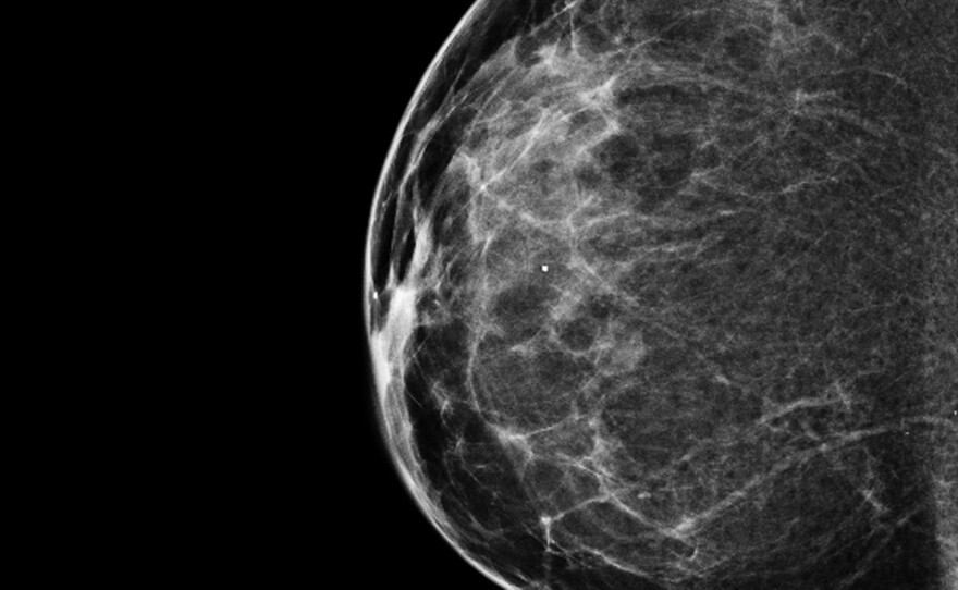 A 3-D mammogram reveals a normal breast.