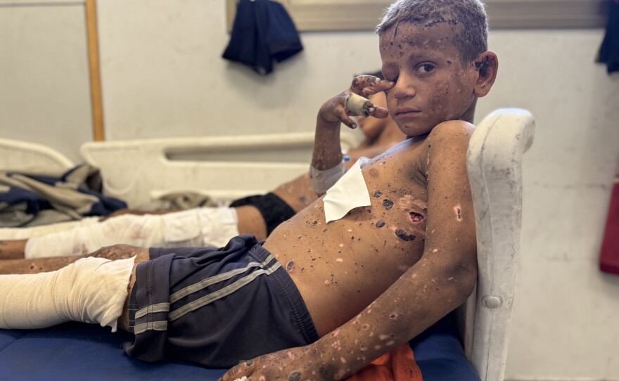 At Al-Shifa Hospital on Oct. 23, 2025, Joud Al-Angar, 12, and his younger cousin are covered in dime-sized scabs after they were wounded by a piece of shrapnel from an Israeli munition. They found it in the rubble and thought it was coal they could use to help their family cook dinner.