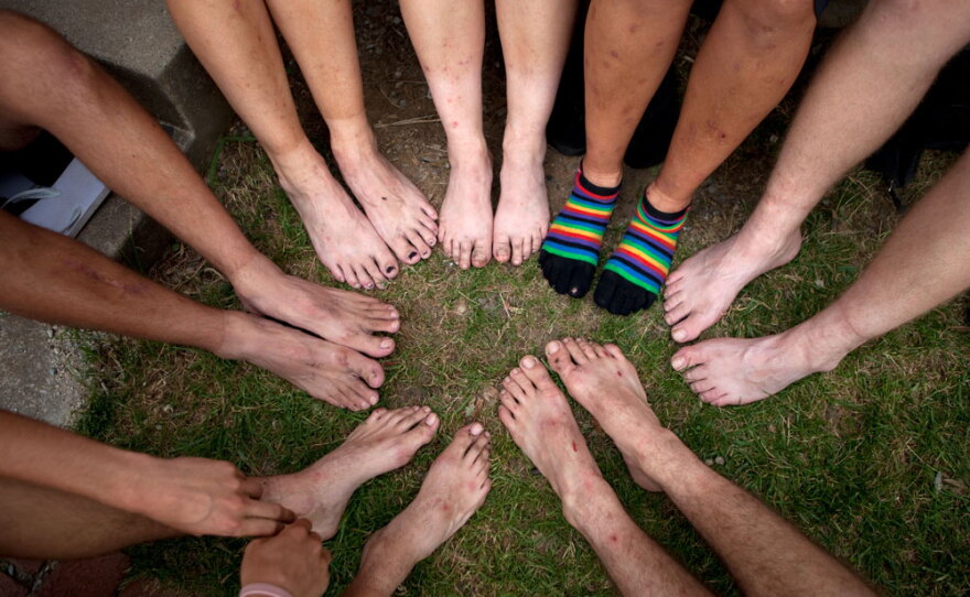 Bug-bitten and blistered, hikers display their feet at the office of the Appalachian Trail Conservancy at Harpers Ferry.