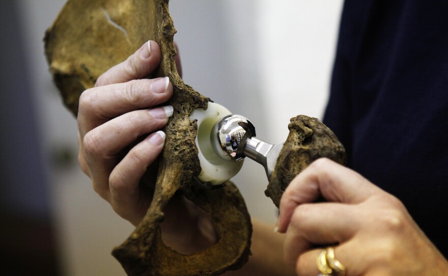 Contemporary skeletons show researchers the side effects of modern medicine, like a hip replacement (shown above).