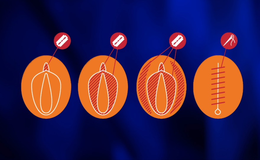 This diagram shows the different types of female genital mutilation – from partial removal of the clitoris to extraction of all labia and stitching shut of the area.