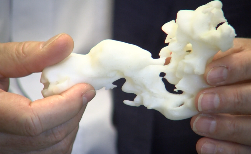 Larry Smarr holds a 3D-printed replica of the section of his colon removed in a recent surgery, Feb. 22, 2017. 