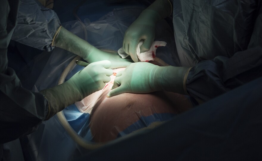 Surgeons perform a cesarean section. A new report raises concerns about rising rates of this procedure around the world, from Brazil to China.