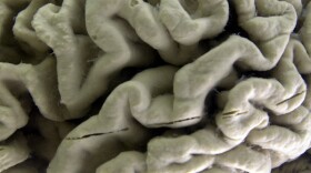 A section of a human brain with Alzheimer's disease is on display at the Museum of Neuroanatomy at the University at Buffalo, in Buffalo, N.Y., Oct. 7, 2003. 