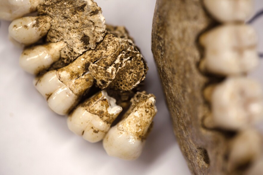 Owsley says the teeth of the skeletons show signs of decay that would have been painful when the men were alive.