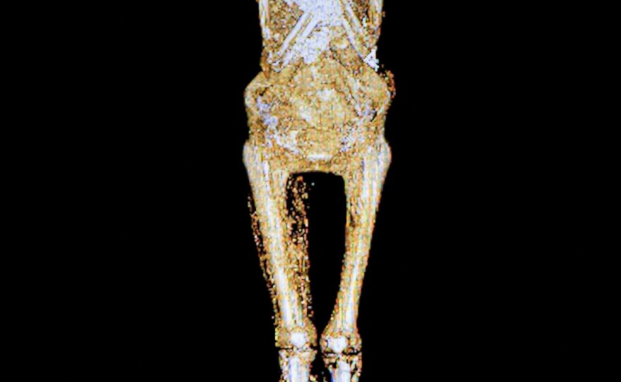 The remains of a man who lived more than two millennia ago show some of the bad effects of inactivity and poor diet.