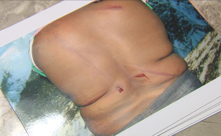 Photographs show long, thing welts and gashes on Syvlie's back, which she endured after a boyfriend abused her for being a lesbian, July 5, 2017.