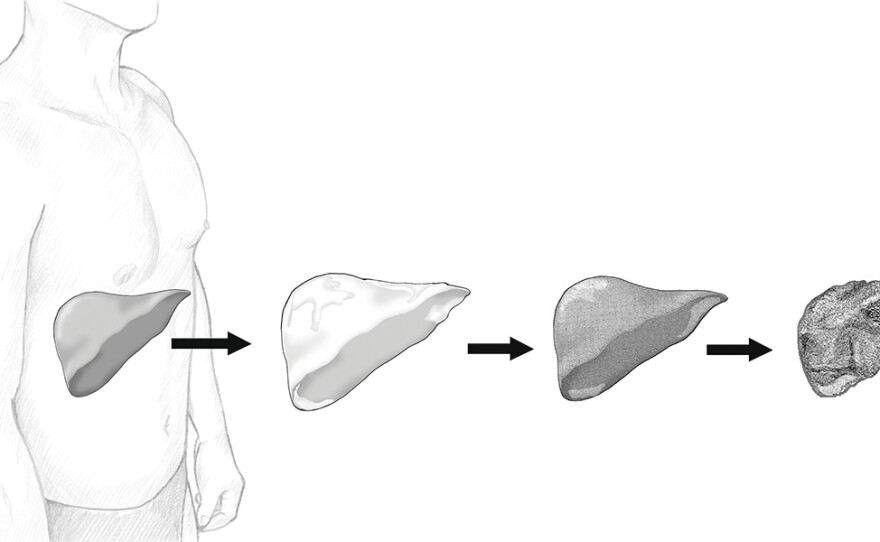A drawing of the stages of liver damage leading to cirrhosis is shown in this undated image.