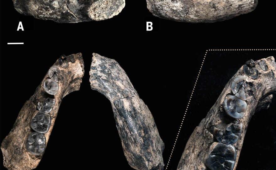 Five views of the fossilized jawbone highlight teeth that are becoming more slender, scientists say, relative to the blocky, more ape-like teeth of Austraolpithecus.