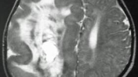 Hemimegalencephaly, a rare condition that causes asymmetrical brain growth.