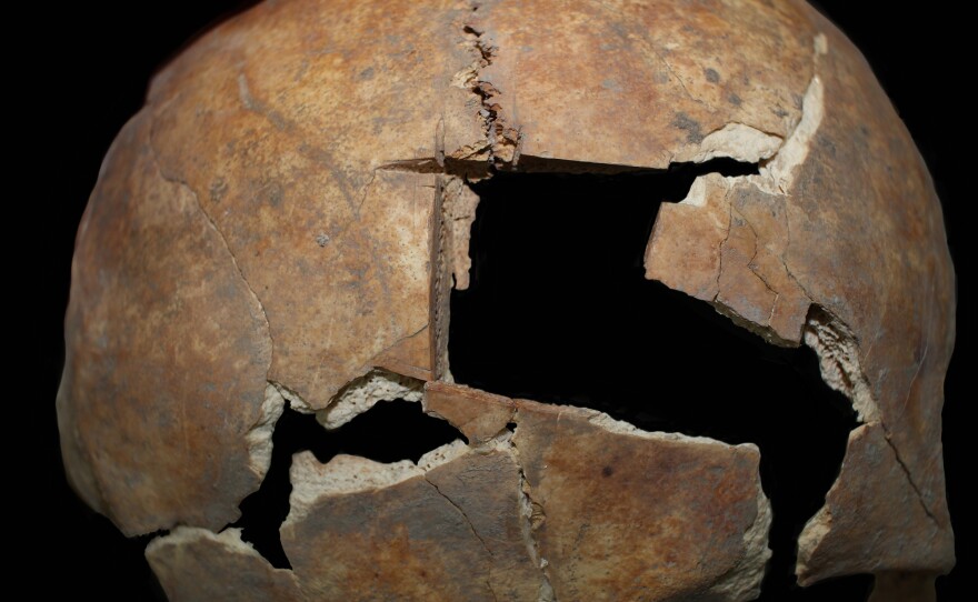 This hole was made in a Bronze Age man's skull shortly before he died, archaeologists say, based on several clues. It's the result of a surgical procedure called a trephination.