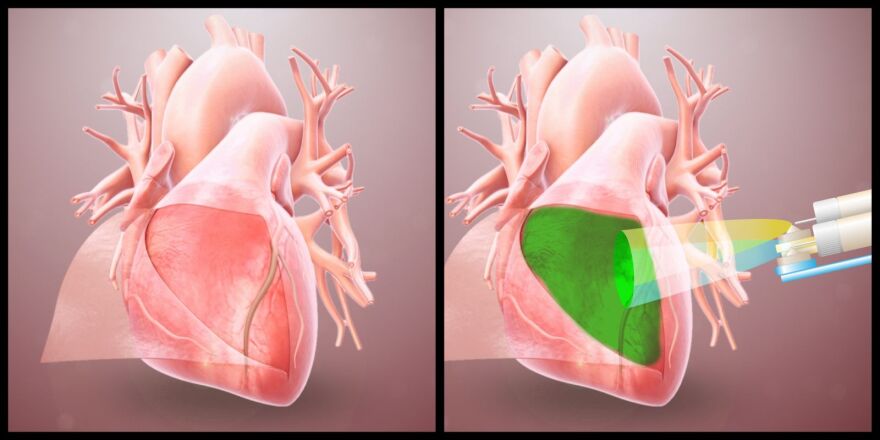 Illustration shows a heart missing its protective layer following surgery and how an an astrogel can be applied to the area to protect it as the heart heals.