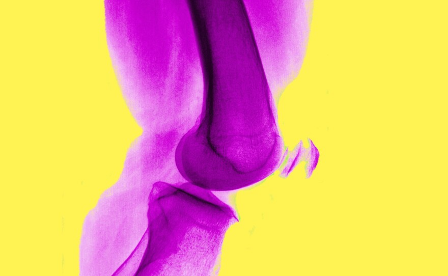 Arthritis of the knee is very common, and isn't helped by arthroscopic surgery, a study finds.