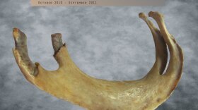 This specimen displays a fusion between the 2nd and 3rd ribs, a congenital abnormality known as bifurcated ribs. The ribs are separate at their vertebral ends, but become a single rib at their midpoint and remain fused all the way to the sternal end.
