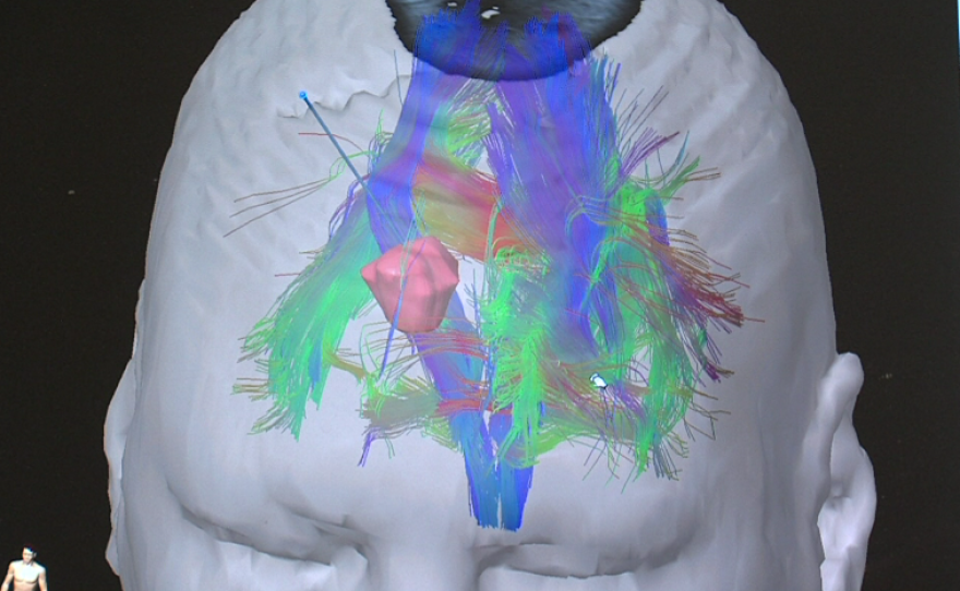 A 3D image, produced by a method called tractography, displays the neural connections in Carpinelli's brain, and shows where her tumor is located. The blue line is the path that Dr. Chen will use to destroy the tumor.